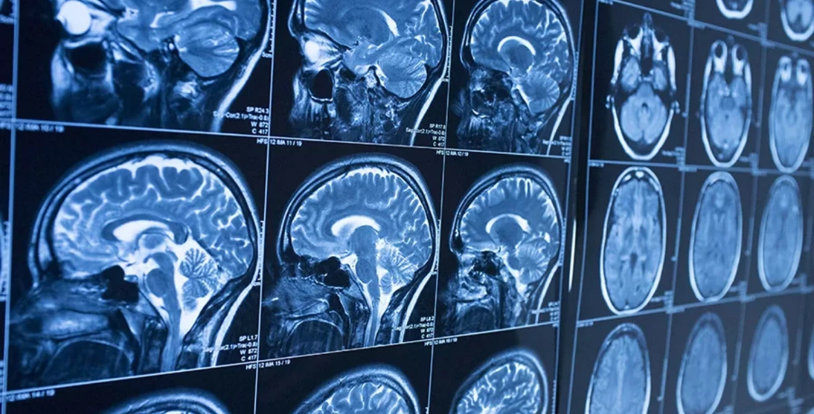 Brain Tumor