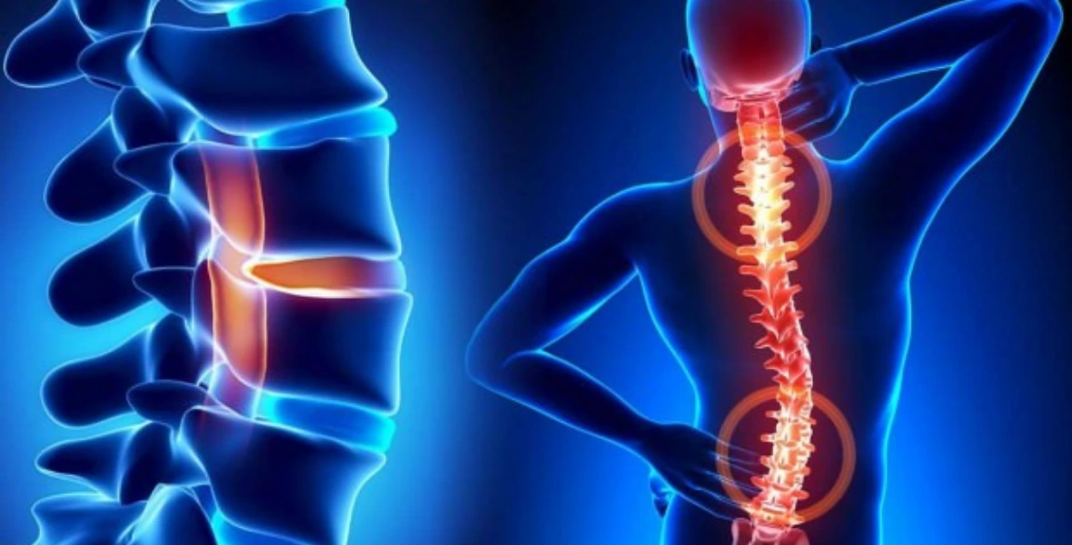 Spinal Canal Stenosis